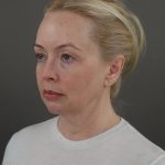 Facelift Before & After Patient #10640