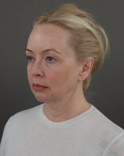 Facelift Before & After Patient #10640