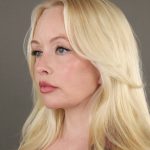 Facelift Before & After Patient #10640