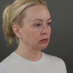 Facelift Before & After Patient #10640