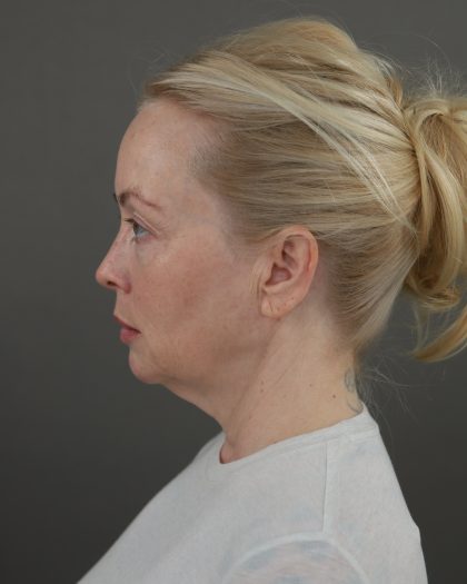 Facelift Before & After Patient #10640