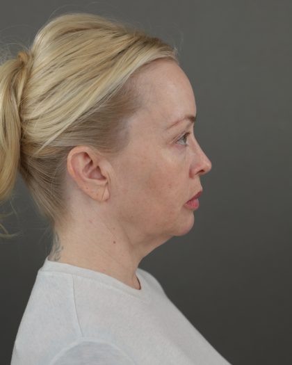 Facelift Before & After Patient #10640